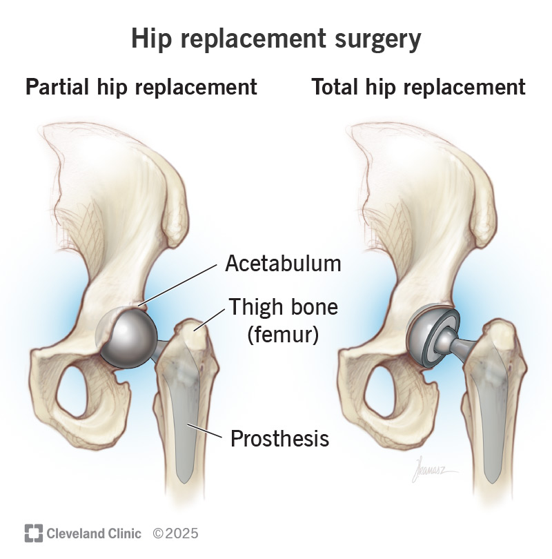 hip replacement surgery