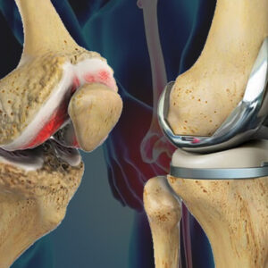 knee replacement