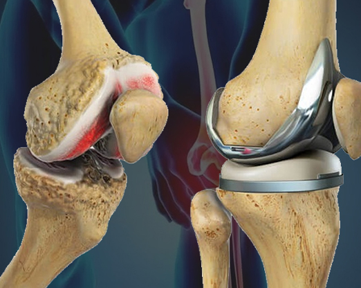knee replacement