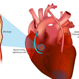 coronary artery bypass grafting (cabg)