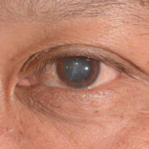 cataract surgery in india