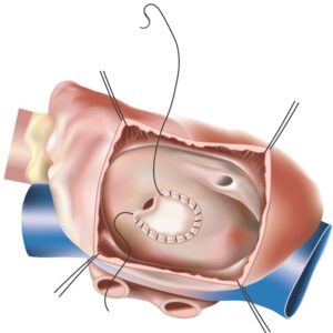 atrial septal defect closure