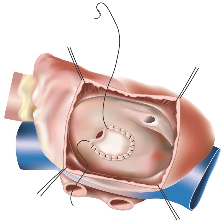atrial septal defect closure