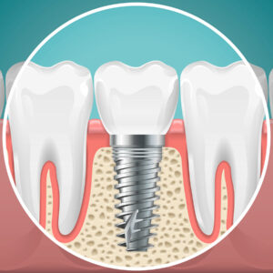 dental implants