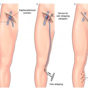 varicose veins surgery