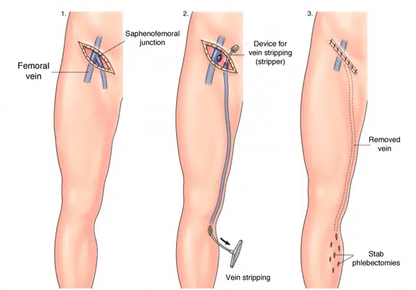 varicose veins surgery