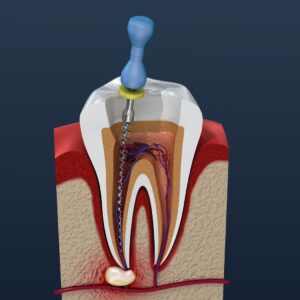 root canal treatment