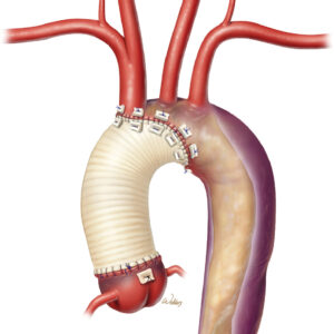 aortic dissection repair surgery