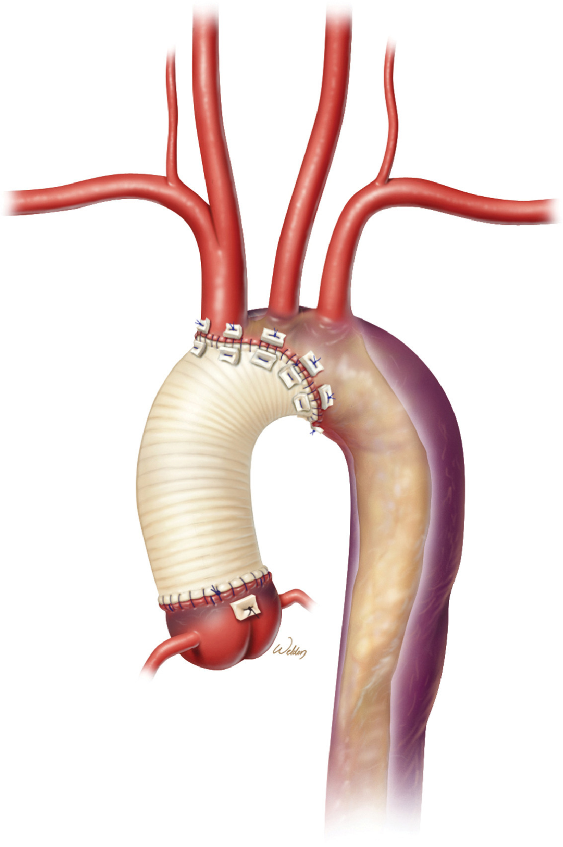 aortic dissection repair surgery