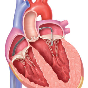heart valve replacement surgery