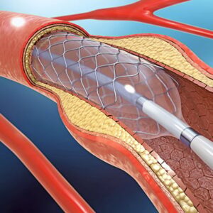 angioplasty and stenting