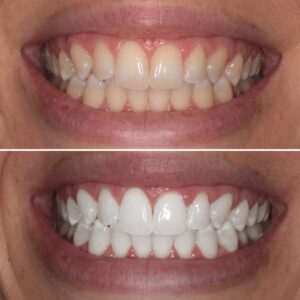 teeth whitening
