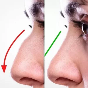 rhinoplasty