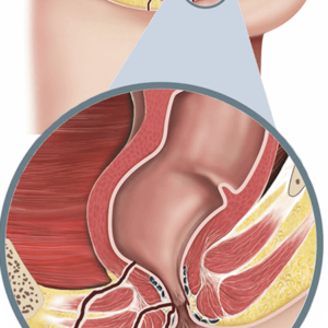 fistula repair surgery